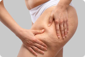 Dermaroller Celulitis